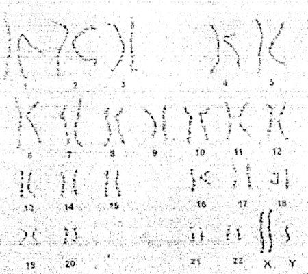 anomalies chromosomiques